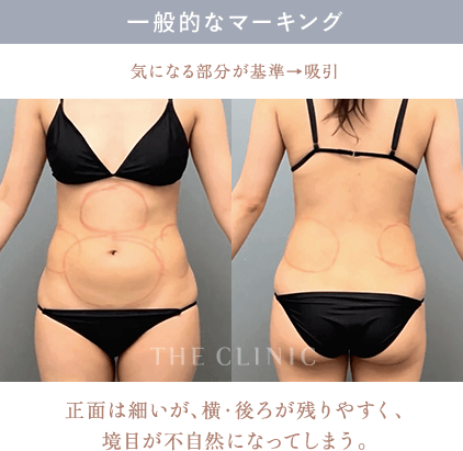 一般的なマーキング 気になる部分が基準→吸引 正面は細いが、横・後ろが残りやすく、境目が不自然になってしまう。