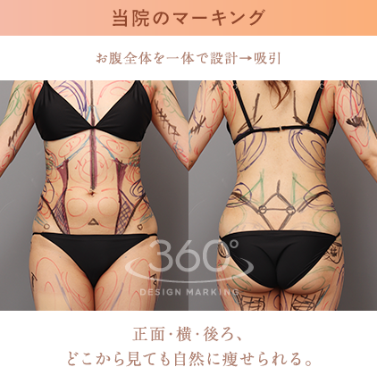 当院のマーキング お腹全体を一体で設計→吸引 正面・横・後ろ、どこから見ても自然に痩せられる。