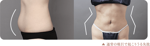 通常の吸引で起こりうる失敗 イメージ