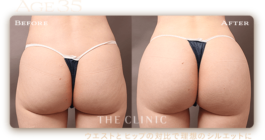 35歳 HIP MAKE by 360°脂肪吸引の症例 ウエストとヒップの対比で理想のシルエットに